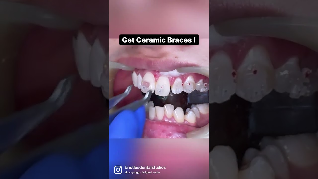 Good alternative to Metal Braces