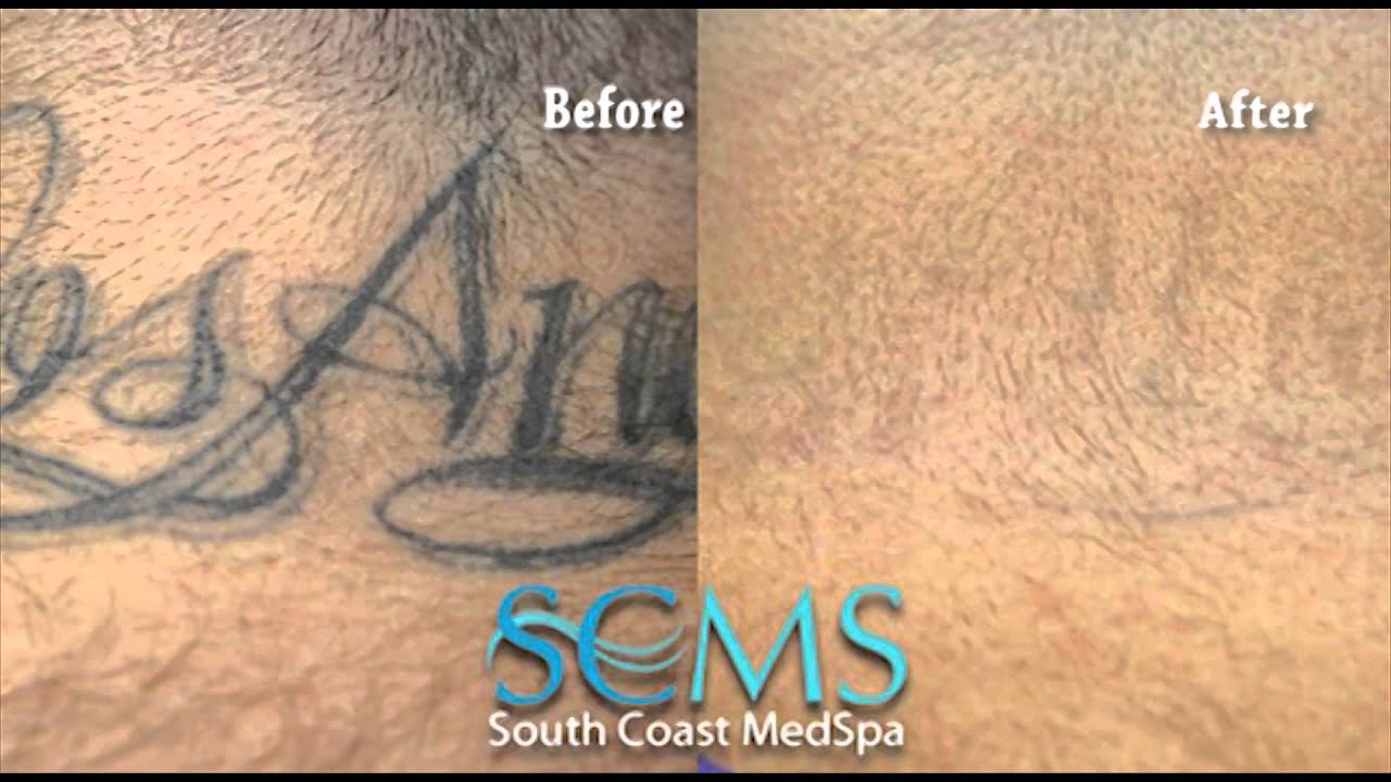 Los Angeles Laser Tattoo Removal (Before and After Photos) - YouTube