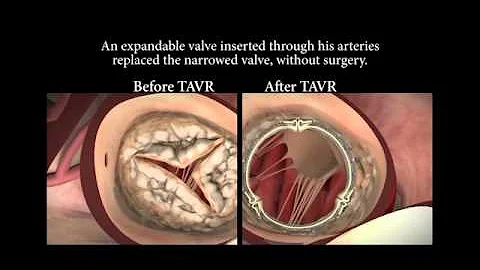 TAVR Heart Valve Replacement - Heart Services - DayDayNews