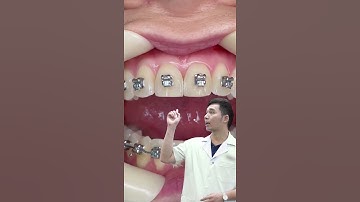 Đây là cách bác sĩ mài kẽ răng để niềng răng