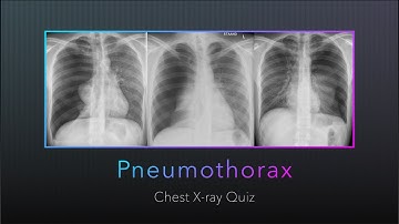 Chest X-ray Quiz: Pneumothorax