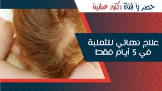 علاج نهائي للثعلبة في 5أيام فقط