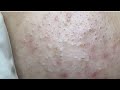 Acne treatment for nguyen p2 hoangmyspa66
