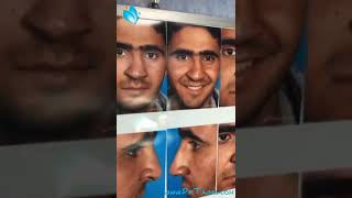 نموذج عملية تجميل الأنف مع الأنحراف الشديد - دكتور تجميل