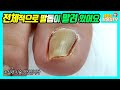 열발톱 전체적으로 말려 있어요 집에서 발톱을 파내면서 자르면 안되는 이유! thick toe nails / ingrowing nails