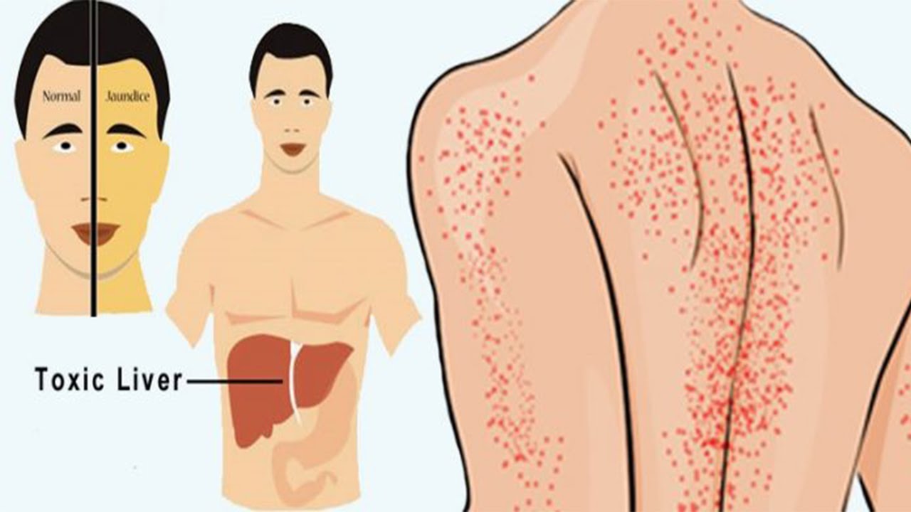 خطير.. إذا ظهرت عليك هذه العلامات تأكدي أنك مصابة بالتهاب الكبد
