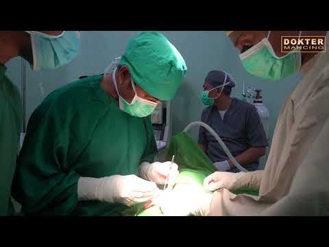 Video: Hernia Pada Garis Putih Perut - Pengobatan, Pengangkatan Dari Anak, Operasi