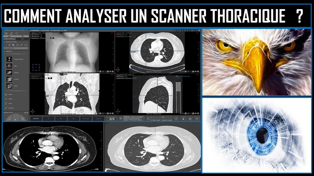 Comment analyser un scanner thoracique 