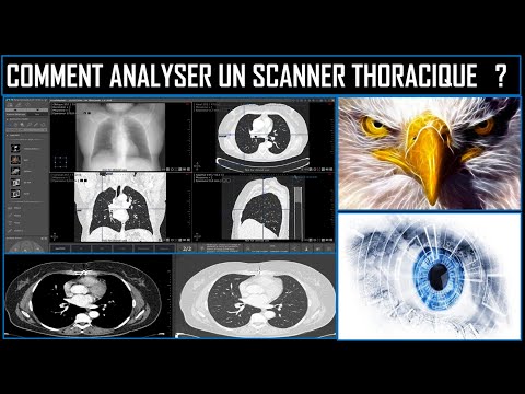 Comment analyser un scanner thoracique ?
