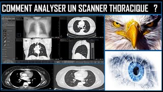 Comment analyser un scanner thoracique ? screenshot 5