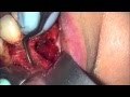 Anterior apical microsurgery