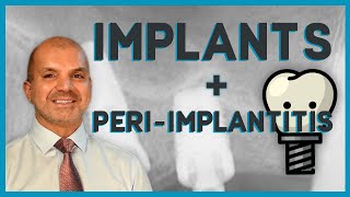Learn Implants in 10 minutes  What Every Dentist Should Know