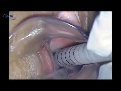 Video: Pelusa Vaginal