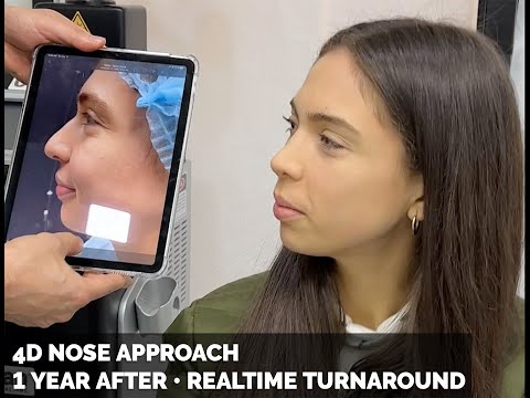 Video thumbnail: 4D Nose Approach - 1 Year After Rhinoplasty - Realtime | As Seen On Instagram & TikTok