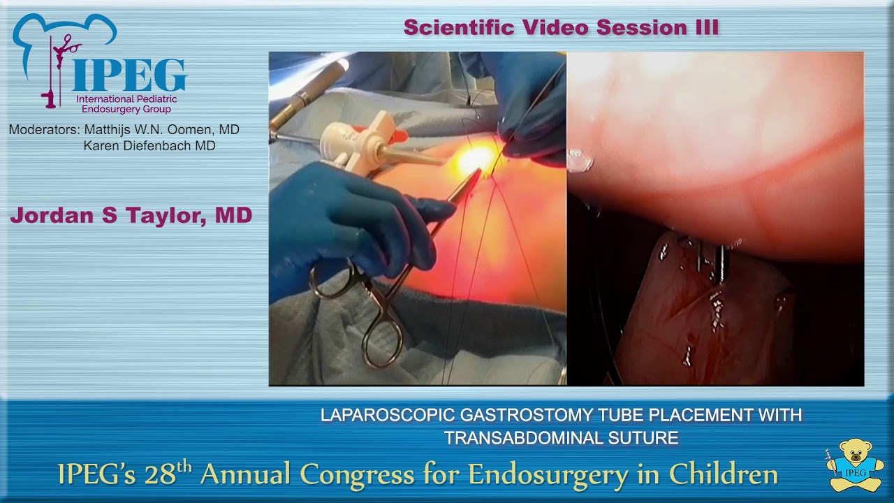 Laparoscopic Gastrostomy Tube Placement With Transabdominal Suture Jordan S Taylor International Pediatric Endosurgery Group