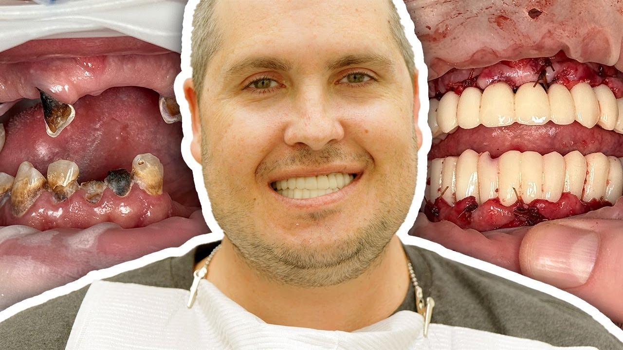 The 3 on 6 Smile Restoration Became His New Lease on Life