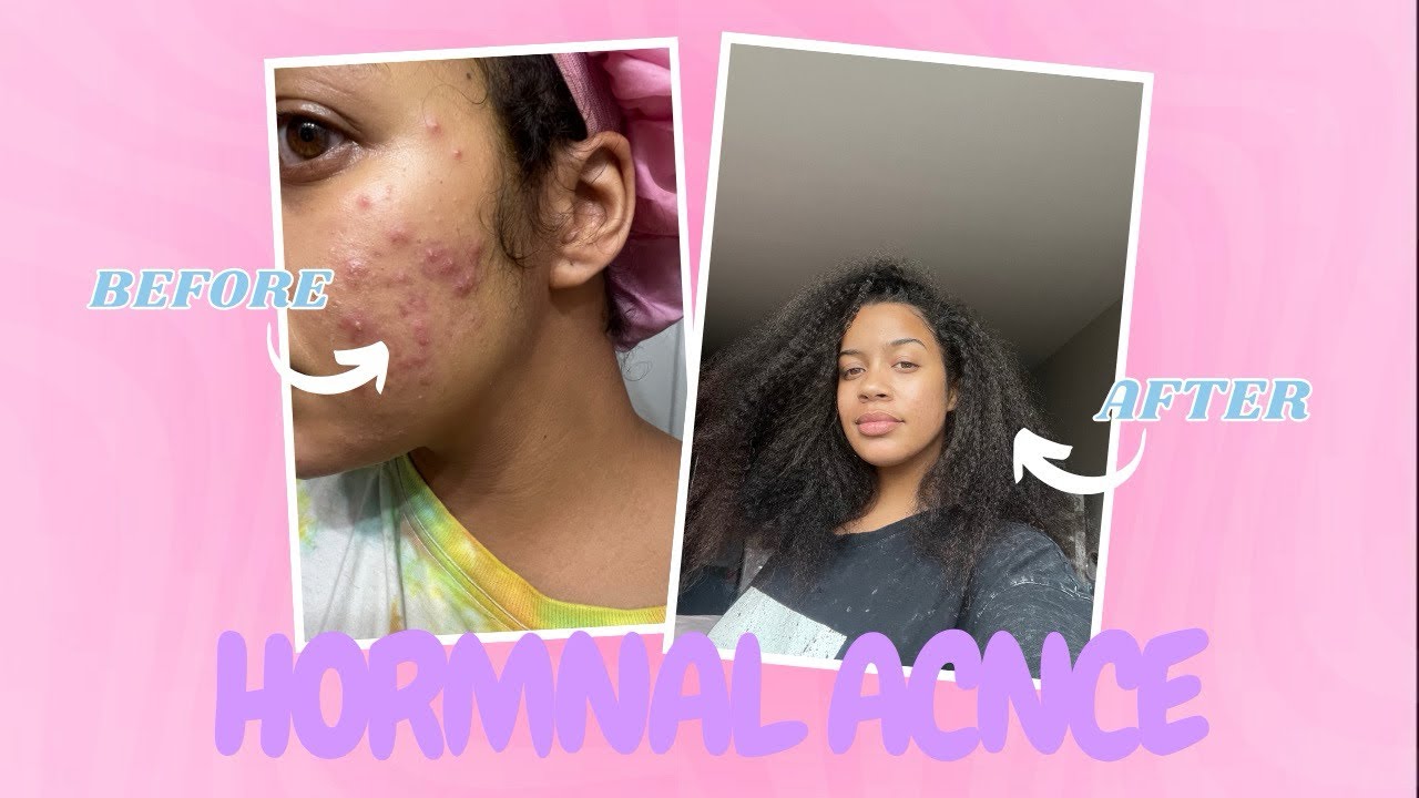 How I Cleared My Hormonal Acne FAST! | My Skincare Routine & Must-Have ...