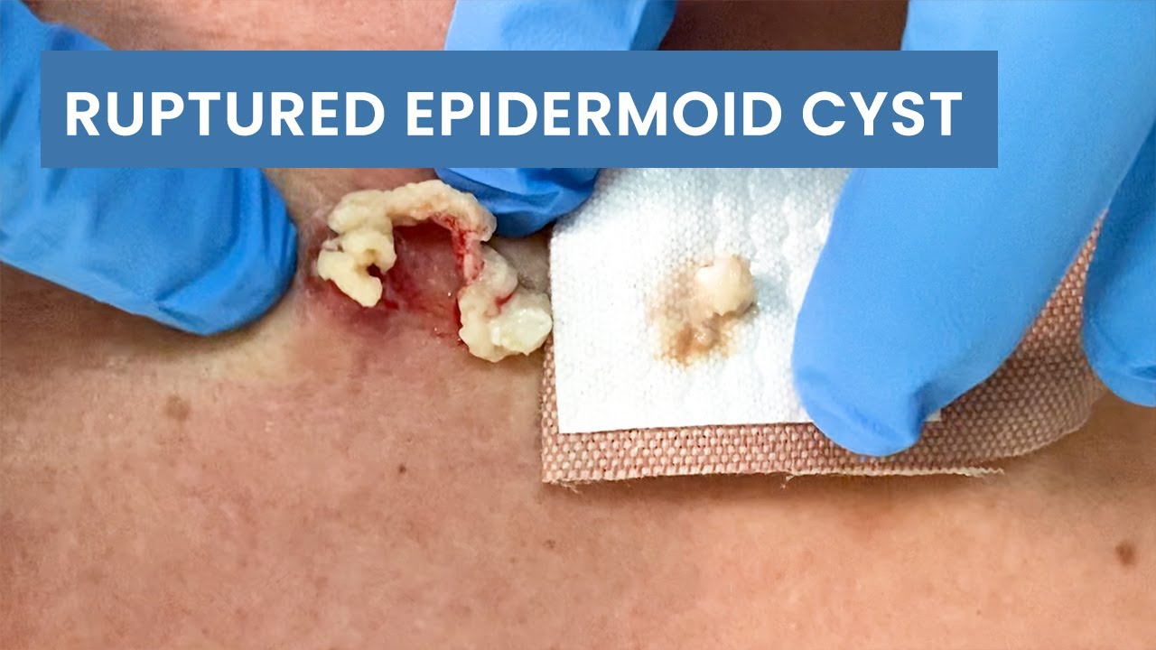 Epidermoid cyst