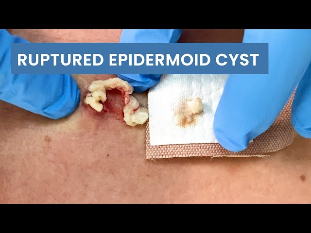 Removing a Ruptured Epidermoid Cyst