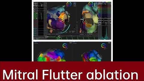 #Mitral #Flutter ablation with rhythmia EPStudy #rhytmia #cardiology  #ablation  #atypicalflutter