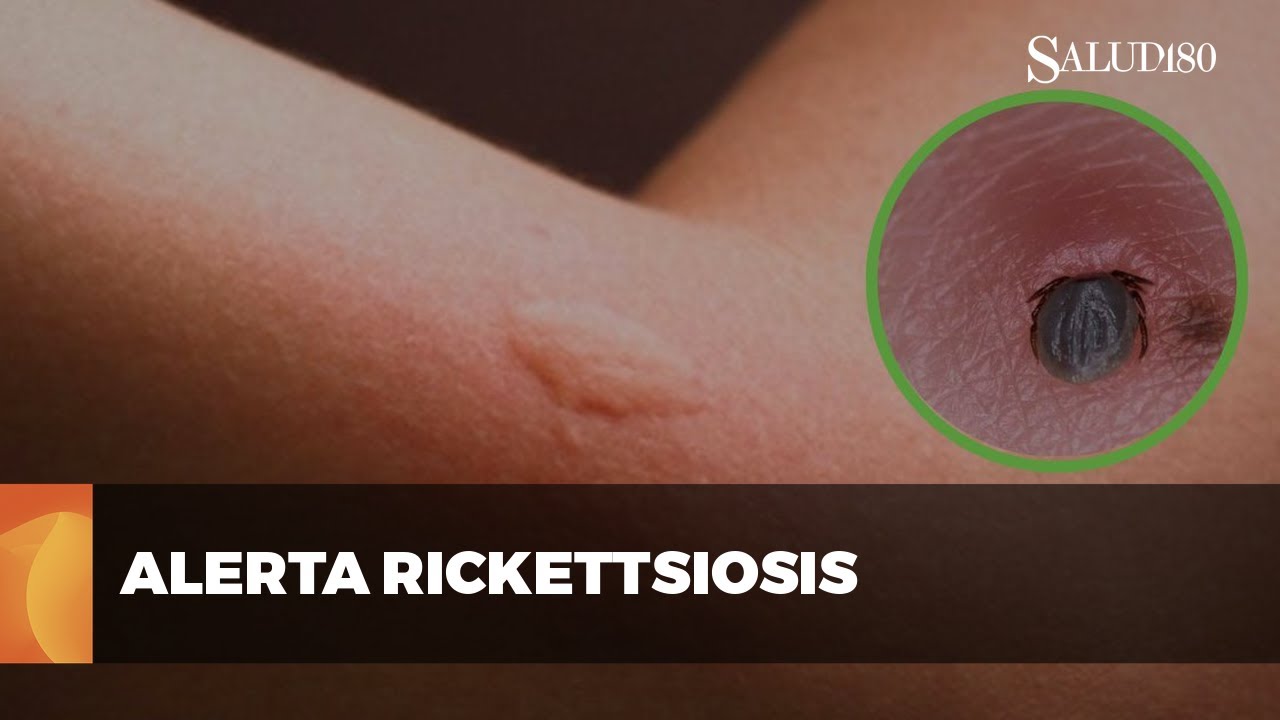 RICKETTSIOSIS | La enfermedad mortal transmitida por garrapatas ...