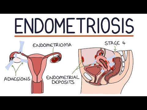 Endometriosis: Visual Explanation for Students