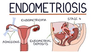 Understanding Endometriosis screenshot 4