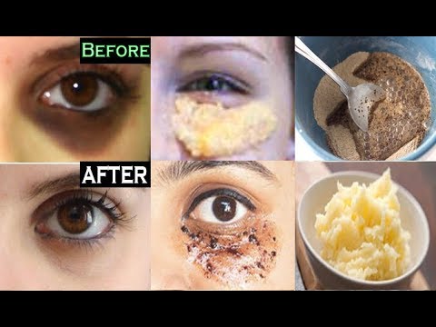 Remove DARK CIRCLES & Under Eye WRINKLES, Eye Bags, Anti Aging Potato Eye mask, Coffee Eye Mask