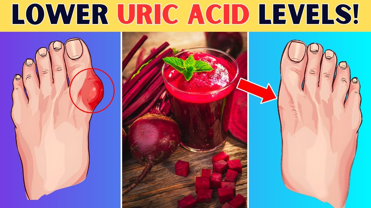 8 Miracle Drinks To STOP High Uric Acid Naturally! YouTube