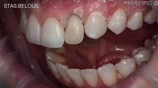Veneers 0.4 mm Vita Suprinity 0m1 HT CAD/CAM CEREC omnicam Zahnfabrik
