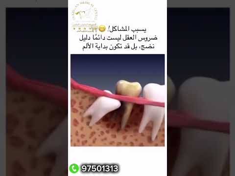 تورم بالفك صعوبة بالمضغ قد يكون السبب ضرس العقل المدفون أو الملتهب اقرأ الوصف