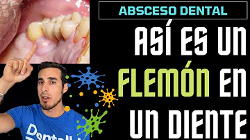 ¿Cuánto dura un absceso dental?