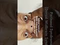 Ref:dsODMWHbz-A Parinaud syndrome-dorsal midbrain syndrome - upward gaze palsy #shorts #neurology #perinaudsyndrome