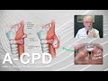 Having Trouble Swallowing Foods and Pills? A-CPD Can Be Treated with Cricopharyngeal Myotomy
