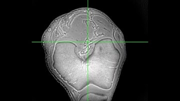 3D Dual-echo Ultra-short Echo Time MRI with Rosette k-Space Pattern