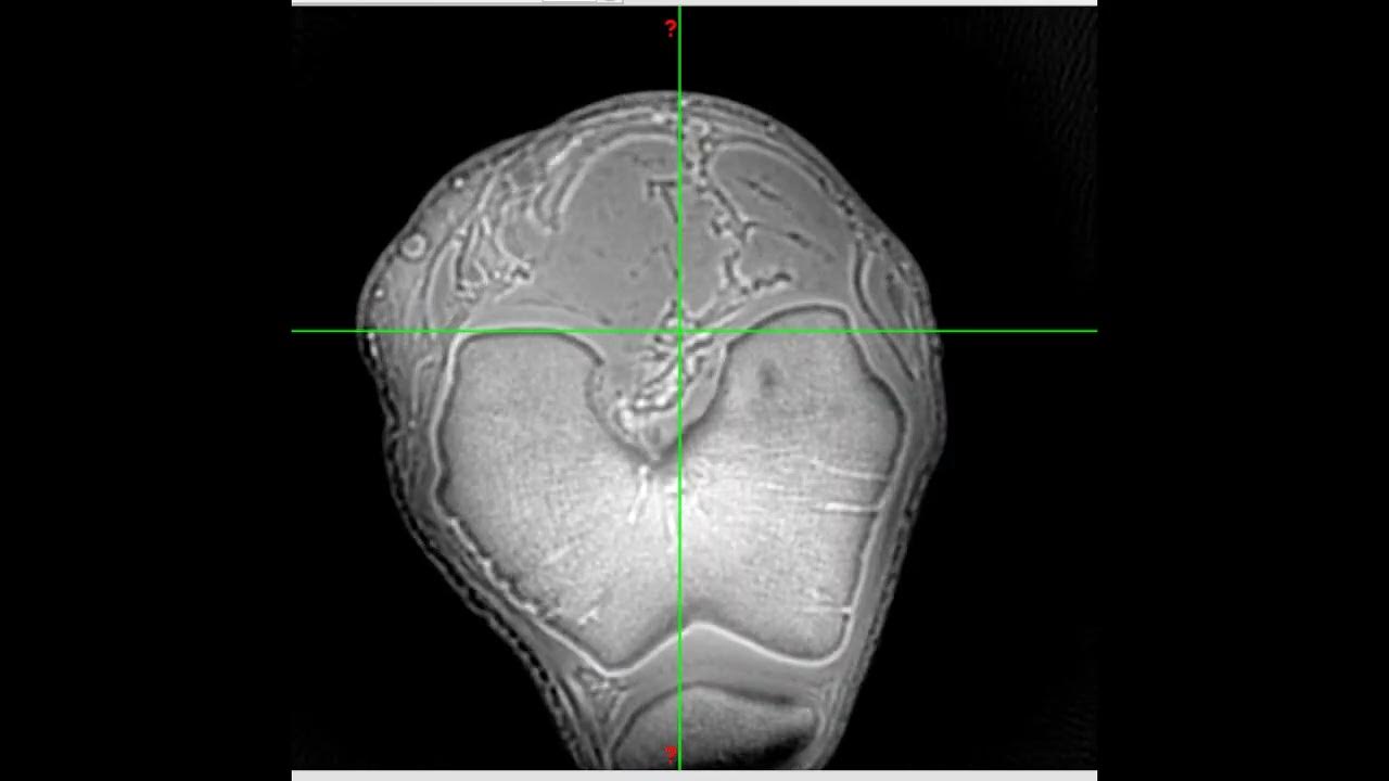 3D Dualecho Ultrashort Echo Time MRI with Rosette kSpace Pattern