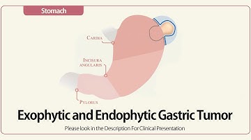 Exophytic and Endophytic Gastric Tumor