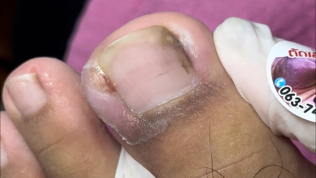 Ep_5838 Ingrown toenail removal 👣 เล็บขบเป็นได้อย่างไร? 😁 (clip from