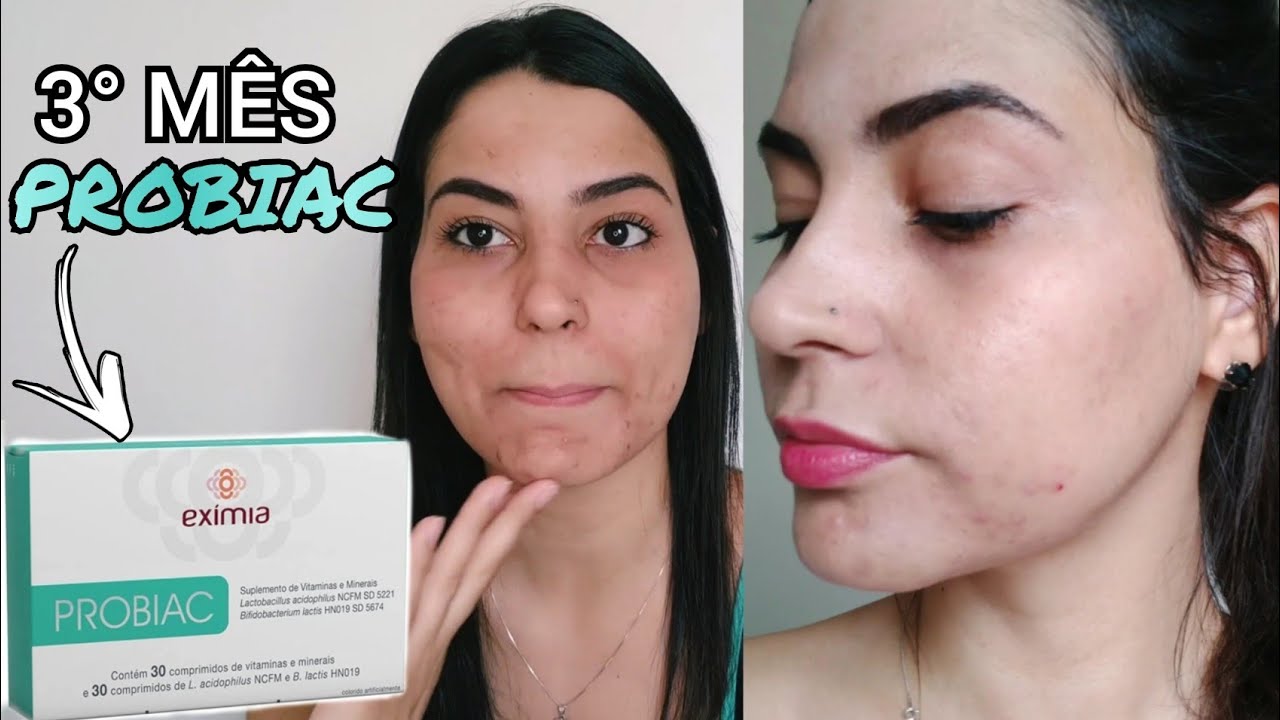 RESENHA PROBIAC EXIMIA 3° MÊS | ACNE HORMONAL | CRIS MARIA - YouTube