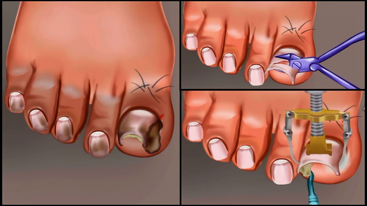 ASMR Taeatment Athlete's Foot And Warts Between Toes At Home Foot Care Animation YouTube