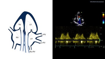 〖Echocardiography〗 The pulmonary veins in TTE