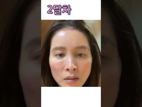 절개리프팅, 심부볼지방제거, 상안검, 눈밑지방재배치, <strong>지방이식</strong> 회복기간 - 제이제이성형외과 #shorts