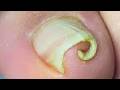 Extremely Curled Toenails With Some Inflammation【Xue Yidao】