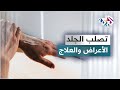 تصل ب الجلد أسبابه وأعراضه وطرق علاجه 