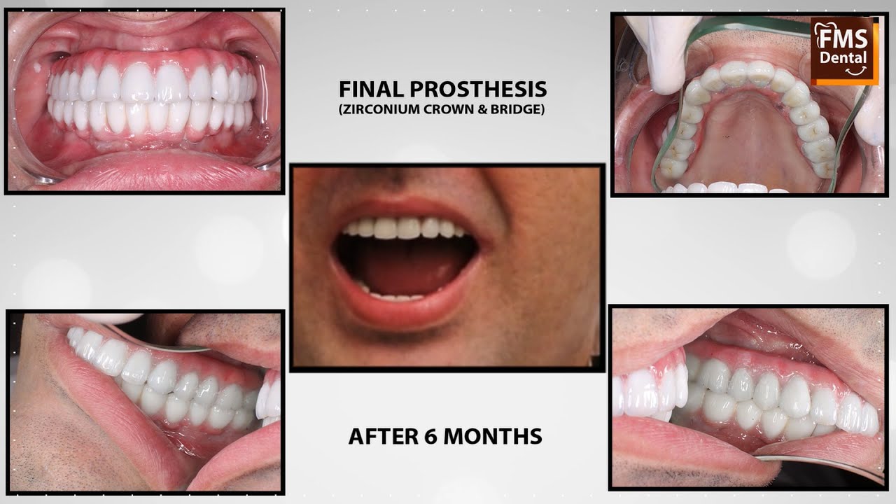 Full Mouth Rehabilitation with Dental Implants Case Study FMS
