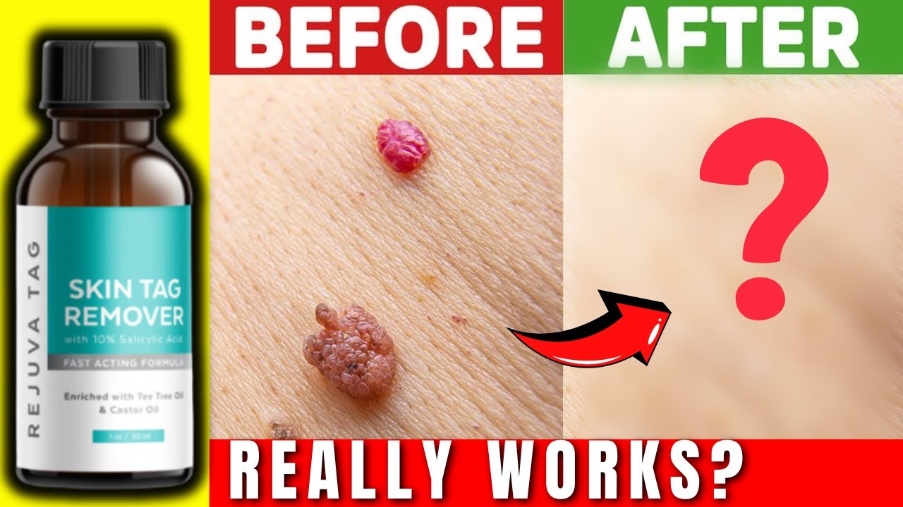 REJUVA TAG - Skin Tag Remover Reviews 🚨 (EXPOSED) Does REJUVA TAG Really  Work? Watch This Review 🔥 - YouTube