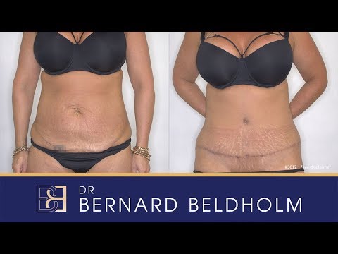 Tummy Tuck post weight loss [Patient 3012]