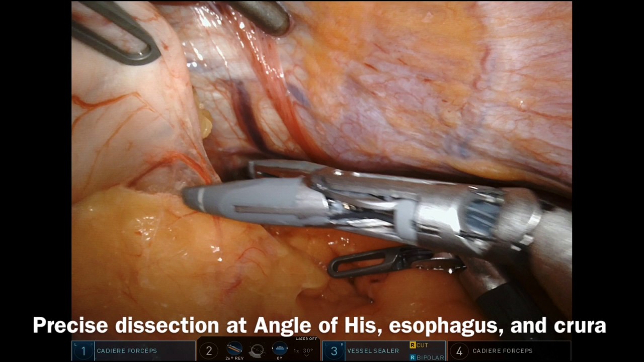 Value of da Vinci for Sleeve Gastrectomy - YouTube
