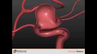 Pipeline Embolization Device Demonstration