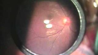 Topcon OMS-800 OFISS Slit_D.avi